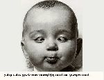 şaşı çocuk